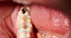 Signs of a Cavity: What You Should Know