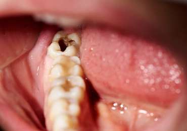 Signs of a Cavity: What You Should Know