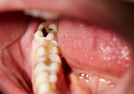 Signs of a Cavity: What You Should Know