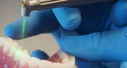 Laser Dentistry: The New Way to Treat the Smile